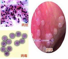 尖锐湿疣最新治疗方法和进展研究